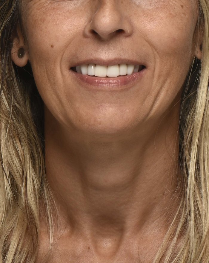 Dopo il trattamento con faccette composite