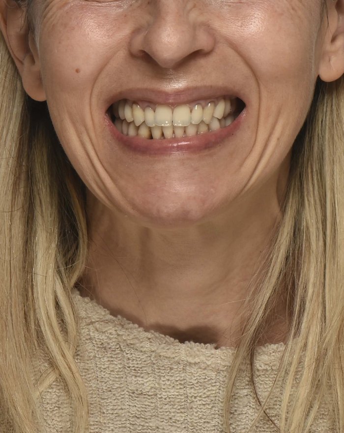 Prima del trattamento con faccette composite