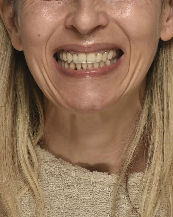 Prima del trattamento con faccette composite